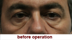 plastic-surgery-blepharoplasty